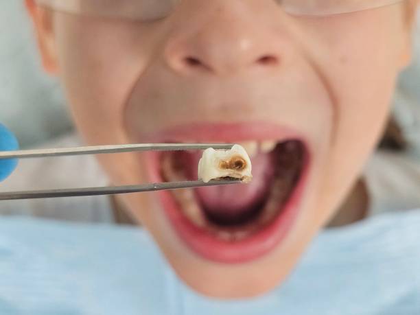 Best Emergency Treatment for Toothache in Auburn, NY